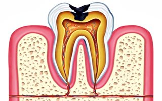 endodontic