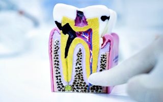 root-canal-treatment