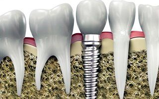 Dental implant